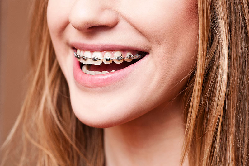 Orthodontics - Eton Dental, Canoga Park Dentist