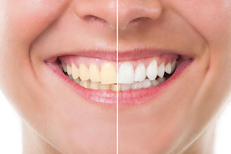 Zoom! Teeth Whitening - Eton Dental, Canoga Park Dentist